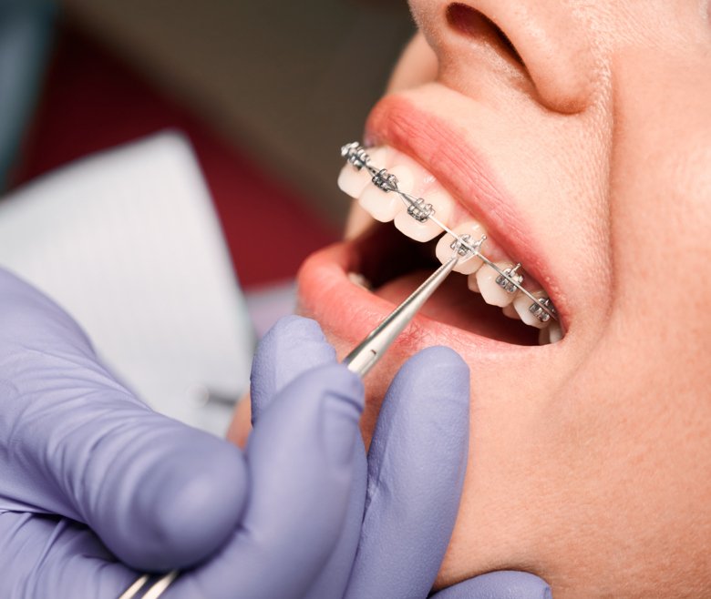 Orthodontist placing rubber bands on female patient braces